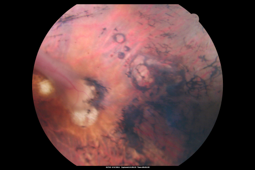 Cicatricial ROP with Macular Folds - 60 Year Old Woman Nystagmus
60-year-old  was born at 6 pounds but then she was incubated and she had difficulty with her eye subsequent to that.
VISUAL ACUITY:  OD 8/200, OS 1/200

