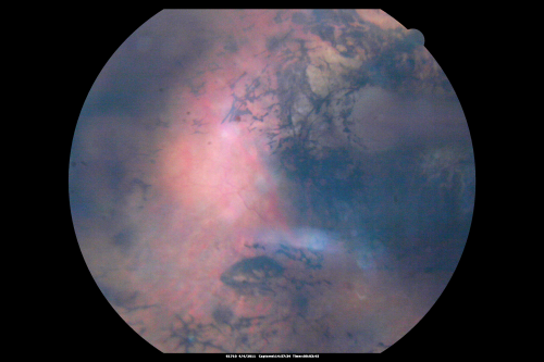 Cicatricial ROP with Macular Folds - 60 Year Old Woman Nystagmus
60-year-old  was born at 6 pounds but then she was incubated and she had difficulty with her eye subsequent to that.
VISUAL ACUITY:  OD 8/200, OS 1/200
