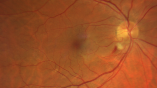 Cilioretinal Artery Occlusion - Good vision
67 year old female - 5 days ago she was getting ready for bed and closed one eye (she had worked for an optometrist for 20 years) and she noticed a spot in the vision in the right eye and came in.  She has no focal neurological problems.  She once in a while gets some weakness.  She has a neurologist and there are some brain lesions.  Father had stroke at age 52.
VA OD: Dcc20/20 NccJ1
VA OS: Dcc20/16-2 NccJ1-2
