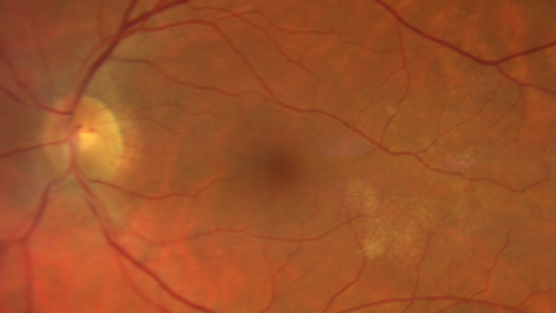 Cilioretinal Artery Occlusion - Good vision
67 year old female - 5 days ago she was getting ready for bed and closed one eye (she had worked for an optometrist for 20 years) and she noticed a spot in the vision in the right eye and came in.  She has no focal neurological problems.  She once in a while gets some weakness.  She has a neurologist and there are some brain lesions.  Father had stroke at age 52.
VA OD: Dcc20/20 NccJ1
VA OS: Dcc20/16-2 NccJ1-2
