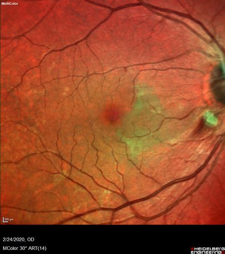Cilioretinal Artery Occlusion - Good vision
67 year old female - 5 days ago she was getting ready for bed and closed one eye (she had worked for an optometrist for 20 years) and she noticed a spot in the vision in the right eye and came in.  She has no focal neurological problems.  She once in a while gets some weakness.  She has a neurologist and there are some brain lesions.  Father had stroke at age 52.
VA OD: Dcc20/20 NccJ1
VA OS: Dcc20/16-2 NccJ1-2

