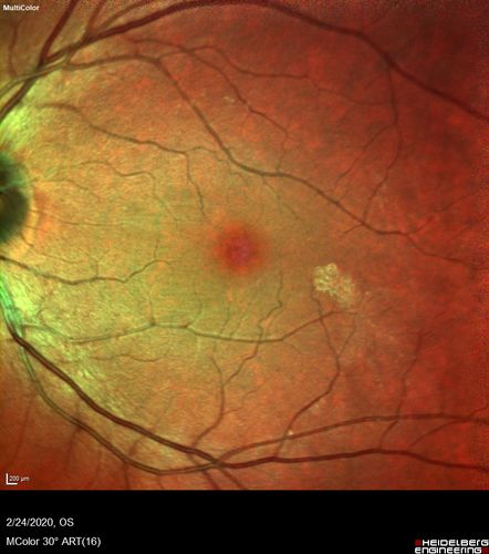Cilioretinal Artery Occlusion - Good vision
67 year old female - 5 days ago she was getting ready for bed and closed one eye (she had worked for an optometrist for 20 years) and she noticed a spot in the vision in the right eye and came in.  She has no focal neurological problems.  She once in a while gets some weakness.  She has a neurologist and there are some brain lesions.  Father had stroke at age 52.
VA OD: Dcc20/20 NccJ1
VA OS: Dcc20/16-2 NccJ1-2
