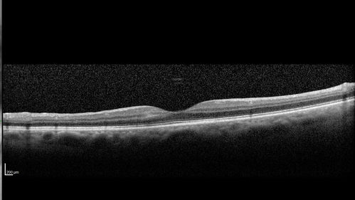 Cilioretinal Artery Occlusion - Good vision
67 year old female - 5 days ago she was getting ready for bed and closed one eye (she had worked for an optometrist for 20 years) and she noticed a spot in the vision in the right eye and came in.  She has no focal neurological problems.  She once in a while gets some weakness.  She has a neurologist and there are some brain lesions.  Father had stroke at age 52.
VA OD: Dcc20/20 NccJ1
VA OS: Dcc20/16-2 NccJ1-2
