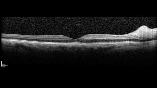 Cilioretinal Artery Occlusion - Good vision
67 year old female - 5 days ago she was getting ready for bed and closed one eye (she had worked for an optometrist for 20 years) and she noticed a spot in the vision in the right eye and came in.  She has no focal neurological problems.  She once in a while gets some weakness.  She has a neurologist and there are some brain lesions.  Father had stroke at age 52.
VA OD: Dcc20/20 NccJ1
VA OS: Dcc20/16-2 NccJ1-2
