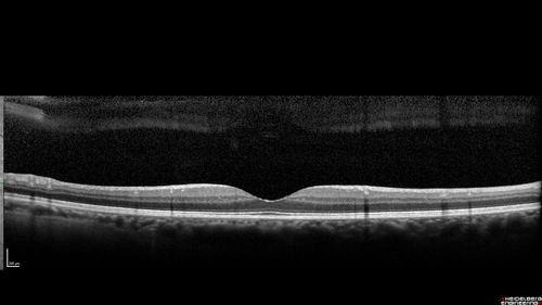 Cilioretinal Artery Occlusion - Good vision
67 year old female - 5 days ago she was getting ready for bed and closed one eye (she had worked for an optometrist for 20 years) and she noticed a spot in the vision in the right eye and came in.  She has no focal neurological problems.  She once in a while gets some weakness.  She has a neurologist and there are some brain lesions.  Father had stroke at age 52.
VA OD: Dcc20/20 NccJ1
VA OS: Dcc20/16-2 NccJ1-2
