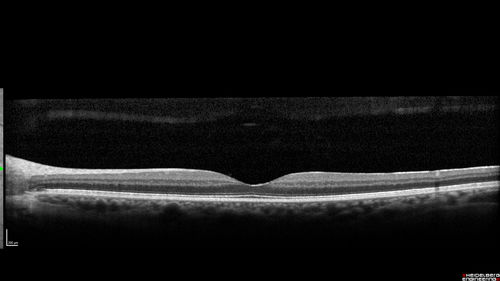 Cilioretinal Artery Occlusion - Good vision
67 year old female - 5 days ago she was getting ready for bed and closed one eye (she had worked for an optometrist for 20 years) and she noticed a spot in the vision in the right eye and came in.  She has no focal neurological problems.  She once in a while gets some weakness.  She has a neurologist and there are some brain lesions.  Father had stroke at age 52.
VA OD: Dcc20/20 NccJ1
VA OS: Dcc20/16-2 NccJ1-2
