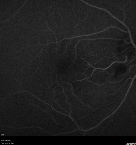 Cilioretinal Artery Occlusion - Good vision
67 year old female - 5 days ago she was getting ready for bed and closed one eye (she had worked for an optometrist for 20 years) and she noticed a spot in the vision in the right eye and came in.  She has no focal neurological problems.  She once in a while gets some weakness.  She has a neurologist and there are some brain lesions.  Father had stroke at age 52.
VA OD: Dcc20/20 NccJ1
VA OS: Dcc20/16-2 NccJ1-2
