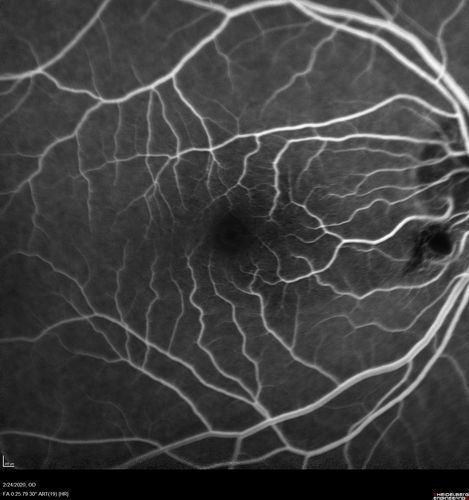 Cilioretinal Artery Occlusion - Good vision
67 year old female - 5 days ago she was getting ready for bed and closed one eye (she had worked for an optometrist for 20 years) and she noticed a spot in the vision in the right eye and came in.  She has no focal neurological problems.  She once in a while gets some weakness.  She has a neurologist and there are some brain lesions.  Father had stroke at age 52.
VA OD: Dcc20/20 NccJ1
VA OS: Dcc20/16-2 NccJ1-2
