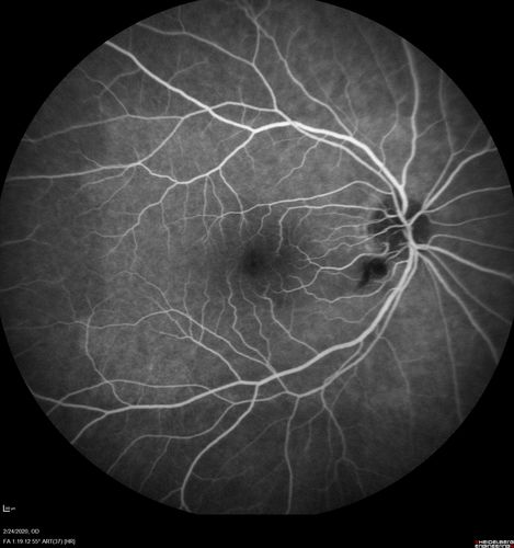 Cilioretinal Artery Occlusion - Good vision
67 year old female - 5 days ago she was getting ready for bed and closed one eye (she had worked for an optometrist for 20 years) and she noticed a spot in the vision in the right eye and came in.  She has no focal neurological problems.  She once in a while gets some weakness.  She has a neurologist and there are some brain lesions.  Father had stroke at age 52.
VA OD: Dcc20/20 NccJ1
VA OS: Dcc20/16-2 NccJ1-2
