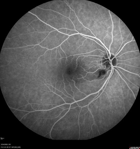 Cilioretinal Artery Occlusion - Good vision
67 year old female - 5 days ago she was getting ready for bed and closed one eye (she had worked for an optometrist for 20 years) and she noticed a spot in the vision in the right eye and came in.  She has no focal neurological problems.  She once in a while gets some weakness.  She has a neurologist and there are some brain lesions.  Father had stroke at age 52.
VA OD: Dcc20/20 NccJ1
VA OS: Dcc20/16-2 NccJ1-2
