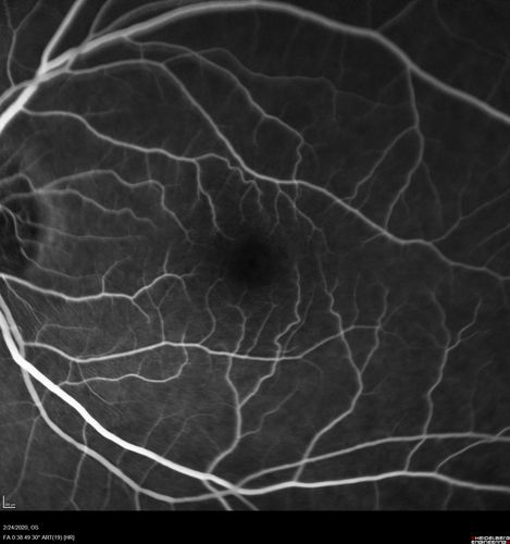 Cilioretinal Artery Occlusion - Good vision
67 year old female - 5 days ago she was getting ready for bed and closed one eye (she had worked for an optometrist for 20 years) and she noticed a spot in the vision in the right eye and came in.  She has no focal neurological problems.  She once in a while gets some weakness.  She has a neurologist and there are some brain lesions.  Father had stroke at age 52.
VA OD: Dcc20/20 NccJ1
VA OS: Dcc20/16-2 NccJ1-2
