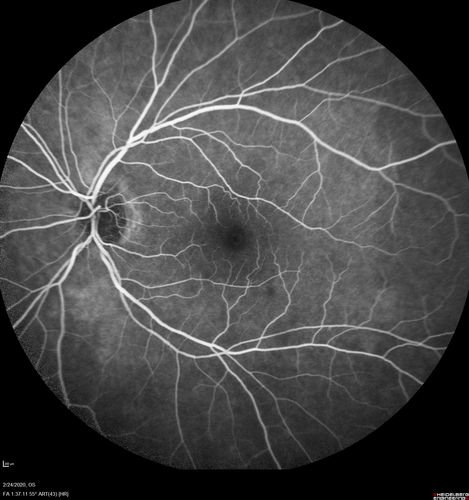 Cilioretinal Artery Occlusion - Good vision
67 year old female - 5 days ago she was getting ready for bed and closed one eye (she had worked for an optometrist for 20 years) and she noticed a spot in the vision in the right eye and came in.  She has no focal neurological problems.  She once in a while gets some weakness.  She has a neurologist and there are some brain lesions.  Father had stroke at age 52.
VA OD: Dcc20/20 NccJ1
VA OS: Dcc20/16-2 NccJ1-2
