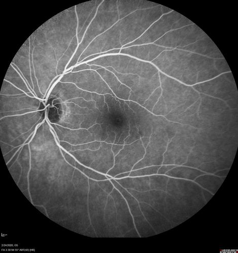 Cilioretinal Artery Occlusion - Good vision
67 year old female - 5 days ago she was getting ready for bed and closed one eye (she had worked for an optometrist for 20 years) and she noticed a spot in the vision in the right eye and came in.  She has no focal neurological problems.  She once in a while gets some weakness.  She has a neurologist and there are some brain lesions.  Father had stroke at age 52.
VA OD: Dcc20/20 NccJ1
VA OS: Dcc20/16-2 NccJ1-2
