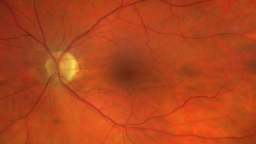cilioretinalarteryocclusion_dosih_20191230_02~0.png
