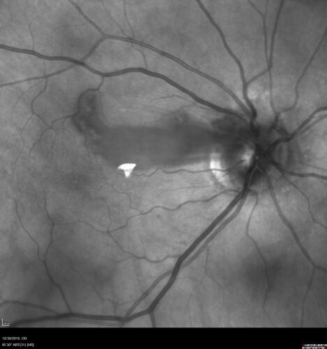 Cilioretinal Artery Occlusion - non central
81 year old female She noticed sudden vision loss in the right eye just before Christmas while watching television.Â  This was about one week ago.Â  She noticed when she closed her left eye and looked out of her right eye there was a darkness in the vision.Â  The left eye is OK.Â  She has no history of stroke and no neurological problems.Â  She had a few headaches recently but they went away.Â Â 
PMHx: HTN, Breast Cancer 
Meds: HCTZ, Atorvastatin, Atenolol, Anastrozole
VA 20/80 OD, 20/32 OS

VA improved to 20/40 in one month in the involved eye
