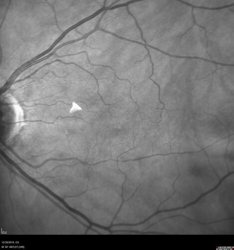 cilioretinalarteryocclusion_dosih_20191230_04~0.jpg