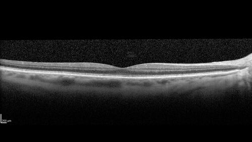 Cilioretinal Artery Occlusion - non central
81 year old female She noticed sudden vision loss in the right eye just before Christmas while watching television.Â  This was about one week ago.Â  She noticed when she closed her left eye and looked out of her right eye there was a darkness in the vision.Â  The left eye is OK.Â  She has no history of stroke and no neurological problems.Â  She had a few headaches recently but they went away.Â Â 
PMHx: HTN, Breast Cancer 
Meds: HCTZ, Atorvastatin, Atenolol, Anastrozole
VA 20/80 OD, 20/32 OS

VA improved to 20/40 in one month in the involved eye
