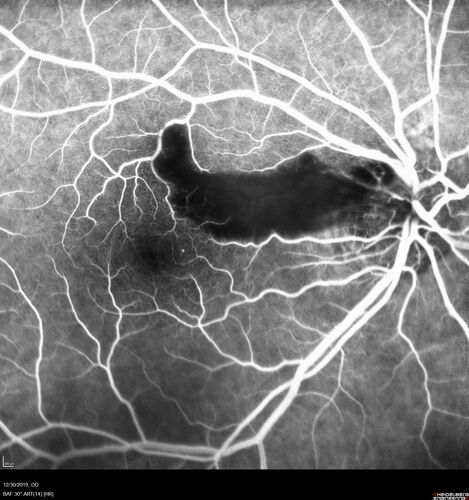 Cilioretinal Artery Occlusion - non central
81 year old female She noticed sudden vision loss in the right eye just before Christmas while watching television.Â  This was about one week ago.Â  She noticed when she closed her left eye and looked out of her right eye there was a darkness in the vision.Â  The left eye is OK.Â  She has no history of stroke and no neurological problems.Â  She had a few headaches recently but they went away.Â Â 
PMHx: HTN, Breast Cancer 
Meds: HCTZ, Atorvastatin, Atenolol, Anastrozole
VA 20/80 OD, 20/32 OS

VA improved to 20/40 in one month in the involved eye
