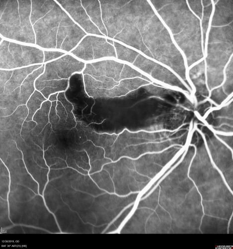 Cilioretinal Artery Occlusion - non central
81 year old female She noticed sudden vision loss in the right eye just before Christmas while watching television.Â  This was about one week ago.Â  She noticed when she closed her left eye and looked out of her right eye there was a darkness in the vision.Â  The left eye is OK.Â  She has no history of stroke and no neurological problems.Â  She had a few headaches recently but they went away.Â Â 
PMHx: HTN, Breast Cancer 
Meds: HCTZ, Atorvastatin, Atenolol, Anastrozole
VA 20/80 OD, 20/32 OS

VA improved to 20/40 in one month in the involved eye
