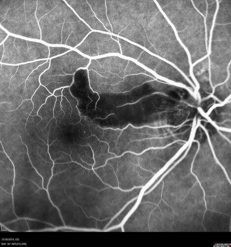 Cilioretinal Artery Occlusion - non central
81 year old female She noticed sudden vision loss in the right eye just before Christmas while watching television.Â  This was about one week ago.Â  She noticed when she closed her left eye and looked out of her right eye there was a darkness in the vision.Â  The left eye is OK.Â  She has no history of stroke and no neurological problems.Â  She had a few headaches recently but they went away.Â Â 
PMHx: HTN, Breast Cancer 
Meds: HCTZ, Atorvastatin, Atenolol, Anastrozole
VA 20/80 OD, 20/32 OS

VA improved to 20/40 in one month in the involved eye

