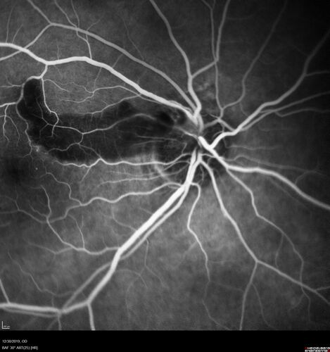 cilioretinalarteryocclusion_dosih_20191230_11~0.jpg