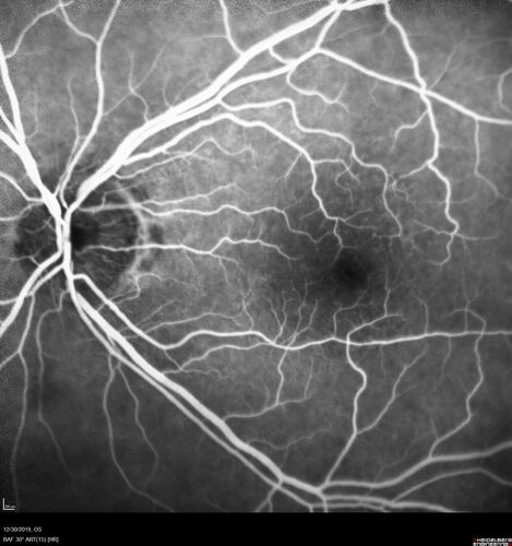 cilioretinalarteryocclusion_dosih_20191230_14.jpg