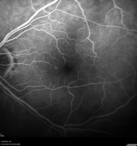 cilioretinalarteryocclusion_dosih_20191230_15.jpg