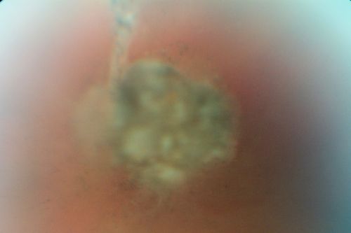 Post Macula Retinal Detachment Repair  On Pneumatic Retinopexy and subsequent Scleral Buckle Vitreous Opacity (No Vitrectomy)
55-year-old man had a scleral buckle for a macula-threatening retinal detachment in the left eye one month ago and a previous pneumatic retinopexy.  Patient sees a big floater. His vision is improving.

VISUAL ACUITY:  Vision OS is 20/50
