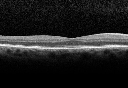 Travatan Induced CME Left eye
63 year old woman 4 years post ECCE and 2 years post PPV for floaters.  She developed CME in the left eye after 1 year of travatan.  The travatan was stopped and the CME and serous retinal detachment resolved.
