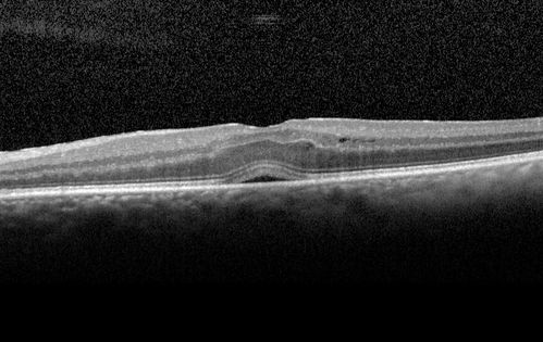 Travatan Induced CME Left eye
63 year old woman 4 years post ECCE and 2 years post PPV for floaters.  She developed CME in the left eye after 1 year of travatan.  The travatan was stopped and the CME and serous retinal detachment resolved.
