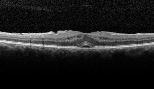 Travatan Induced CME Left eye
63 year old woman 4 years post ECCE and 2 years post PPV for floaters.  She developed CME in the left eye after 1 year of travatan.  The travatan was stopped and the CME and serous retinal detachment resolved.
