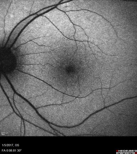 Travatan Induced CME Left eye
63 year old woman 4 years post ECCE and 2 years post PPV for floaters.  She developed CME in the left eye after 1 year of travatan.  The travatan was stopped and the CME and serous retinal detachment resolved.
