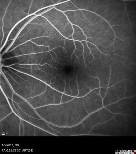 Travatan Induced CME Left eye
63 year old woman 4 years post ECCE and 2 years post PPV for floaters.  She developed CME in the left eye after 1 year of travatan.  The travatan was stopped and the CME and serous retinal detachment resolved.
