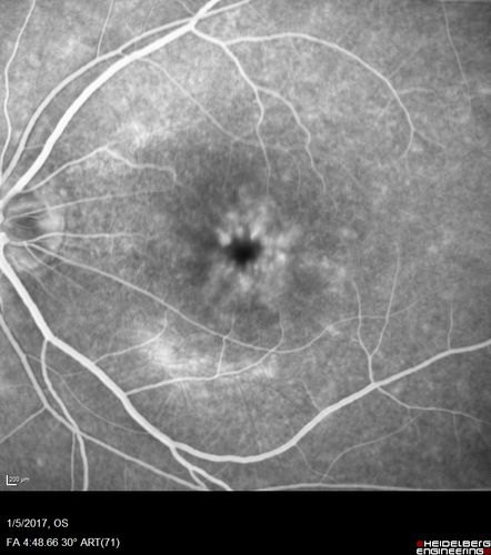 Travatan Induced CME Left eye
63 year old woman 4 years post ECCE and 2 years post PPV for floaters.  She developed CME in the left eye after 1 year of travatan.  The travatan was stopped and the CME and serous retinal detachment resolved.
