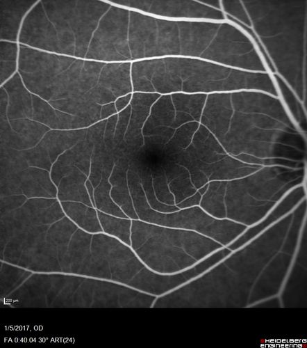 Travatan Induced CME Left eye
63 year old woman 4 years post ECCE and 2 years post PPV for floaters.  She developed CME in the left eye after 1 year of travatan.  The travatan was stopped and the CME and serous retinal detachment resolved.
