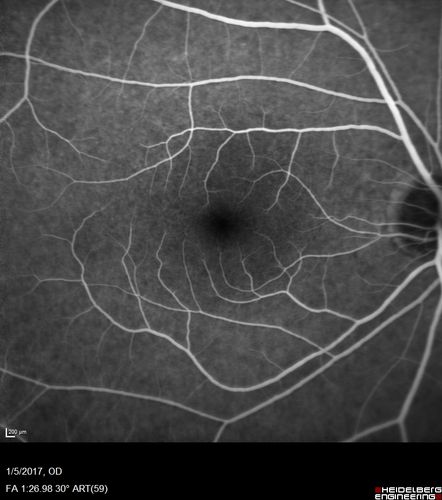 Travatan Induced CME Left eye
63 year old woman 4 years post ECCE and 2 years post PPV for floaters.  She developed CME in the left eye after 1 year of travatan.  The travatan was stopped and the CME and serous retinal detachment resolved.
