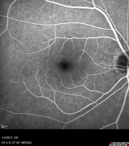 Travatan Induced CME Left eye
63 year old woman 4 years post ECCE and 2 years post PPV for floaters.  She developed CME in the left eye after 1 year of travatan.  The travatan was stopped and the CME and serous retinal detachment resolved.
