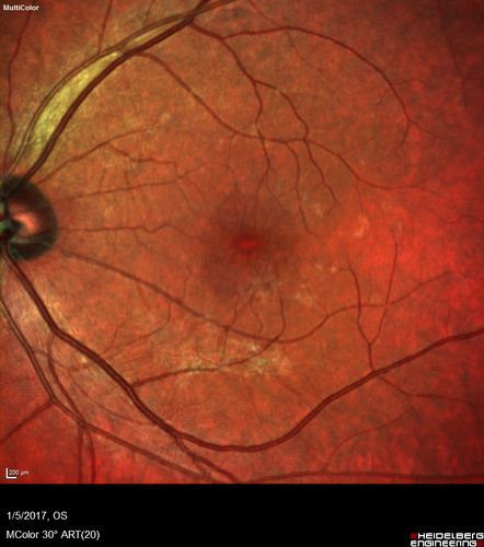 Travatan Induced CME Left eye - 1 month post stopping travatan CME is gone
63 year old woman 4 years post ECCE and 2 years post PPV for floaters.  She developed CME in the left eye after 1 year of travatan.  The travatan was stopped and the CME and serous retinal detachment resolved.
