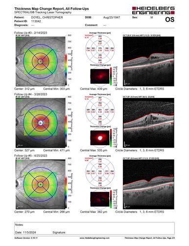 Pseudophakic CME chronic
74 year old man presented 14 weeks after cataract surgery with severe CME on topical therapy.  Multiple attempts to taper drops failed.  Also, the patient had a steroid responsive glaucoma.  He ended up on BID PF, Ketorolac and Dorz/Timolol
