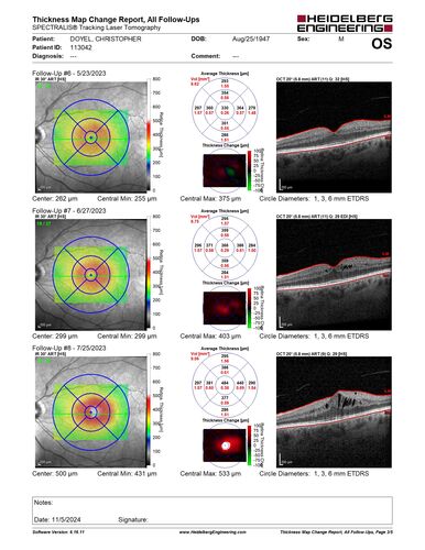 Pseudophakic CME chronic
74 year old man presented 14 weeks after cataract surgery with severe CME on topical therapy.  Multiple attempts to taper drops failed.  Also, the patient had a steroid responsive glaucoma.  He ended up on BID PF, Ketorolac and Dorz/Timolol
