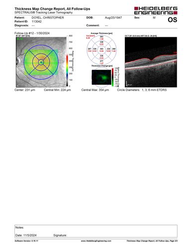 Pseudophakic CME chronic
74 year old man presented 14 weeks after cataract surgery with severe CME on topical therapy.  Multiple attempts to taper drops failed.  Also, the patient had a steroid responsive glaucoma.  He ended up on BID PF, Ketorolac and Dorz/Timolol
