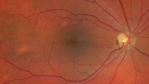 Pseudophakic CME chronic
74 year old man presented 14 weeks after cataract surgery with severe CME on topical therapy.  Multiple attempts to taper drops failed.  Also, the patient had a steroid responsive glaucoma.  He ended up on BID PF, Ketorolac and Dorz/Timolol
