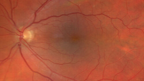 Pseudophakic CME chronic
74 year old man presented 14 weeks after cataract surgery with severe CME on topical therapy.  Multiple attempts to taper drops failed.  Also, the patient had a steroid responsive glaucoma.  He ended up on BID PF, Ketorolac and Dorz/Timolol
