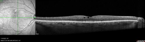 Pseudophakic CME chronic
74 year old man presented 14 weeks after cataract surgery with severe CME on topical therapy.  Multiple attempts to taper drops failed.  Also, the patient had a steroid responsive glaucoma.  He ended up on BID PF, Ketorolac and Dorz/Timolol
