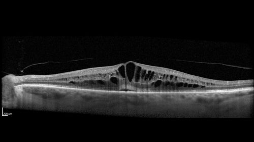 Pseudophakic CME chronic
74 year old man presented 14 weeks after cataract surgery with severe CME on topical therapy.  Multiple attempts to taper drops failed.  Also, the patient had a steroid responsive glaucoma.  He ended up on BID PF, Ketorolac and Dorz/Timolol
