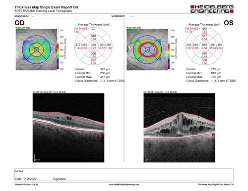 Pseudophakic CME chronic
74 year old man presented 14 weeks after cataract surgery with severe CME on topical therapy.  Multiple attempts to taper drops failed.  Also, the patient had a steroid responsive glaucoma.  He ended up on BID PF, Ketorolac and Dorz/Timolol
