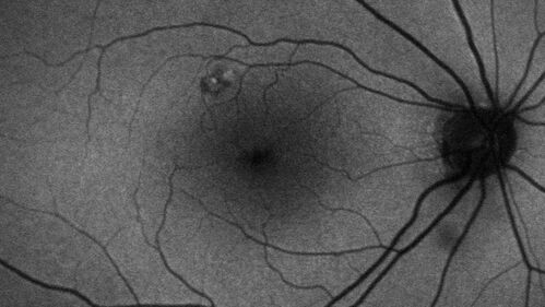 Pseudophakic CME chronic
74 year old man presented 14 weeks after cataract surgery with severe CME on topical therapy.  Multiple attempts to taper drops failed.  Also, the patient had a steroid responsive glaucoma.  He ended up on BID PF, Ketorolac and Dorz/Timolol
