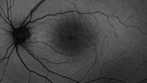 Pseudophakic CME chronic
74 year old man presented 14 weeks after cataract surgery with severe CME on topical therapy.  Multiple attempts to taper drops failed.  Also, the patient had a steroid responsive glaucoma.  He ended up on BID PF, Ketorolac and Dorz/Timolol

