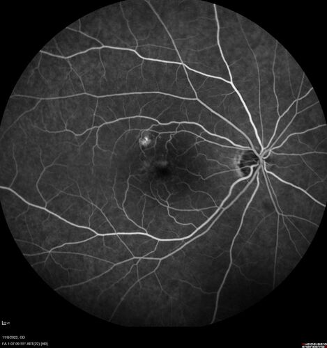 Pseudophakic CME chronic
74 year old man presented 14 weeks after cataract surgery with severe CME on topical therapy.  Multiple attempts to taper drops failed.  Also, the patient had a steroid responsive glaucoma.  He ended up on BID PF, Ketorolac and Dorz/Timolol
