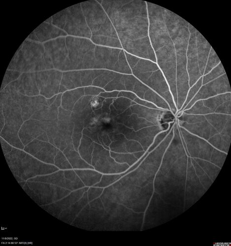 Pseudophakic CME chronic
74 year old man presented 14 weeks after cataract surgery with severe CME on topical therapy.  Multiple attempts to taper drops failed.  Also, the patient had a steroid responsive glaucoma.  He ended up on BID PF, Ketorolac and Dorz/Timolol
